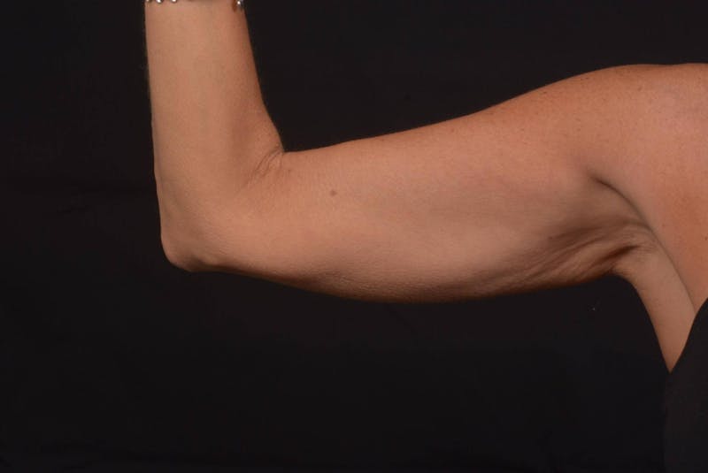 BodyTite Arms Before & After Gallery - Patient 595616 - Image 3