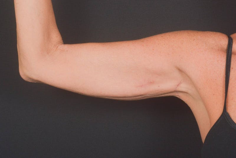 BodyTite Arms Before & After Gallery - Patient 595616 - Image 4