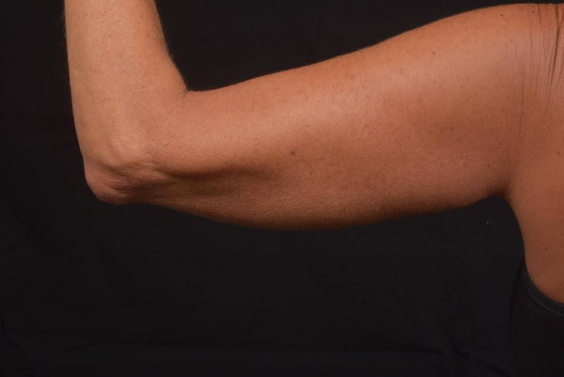 BodyTite Arms Before & After Gallery - Patient 595616 - Image 5