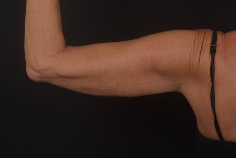 BodyTite Arms Before & After Gallery - Patient 595616 - Image 6