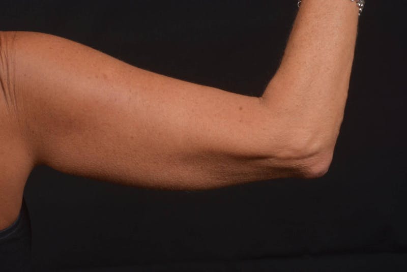 BodyTite Arms Before & After Gallery - Patient 595616 - Image 7