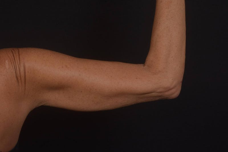 BodyTite Arms Before & After Gallery - Patient 595616 - Image 8