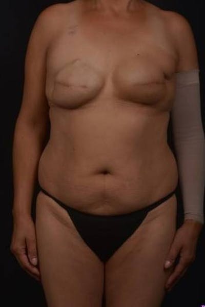 Brazillian Butt Lift Before & After Gallery - Patient 209829 - Image 1