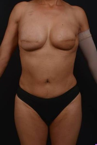 Brazillian Butt Lift Before & After Gallery - Patient 209829 - Image 2