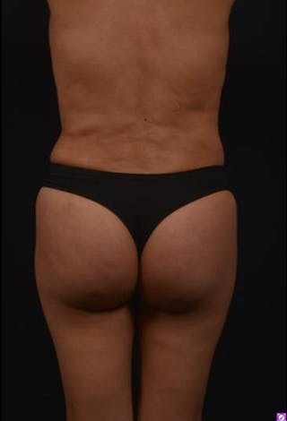 Brazillian Butt Lift Before & After Gallery - Patient 209829 - Image 10