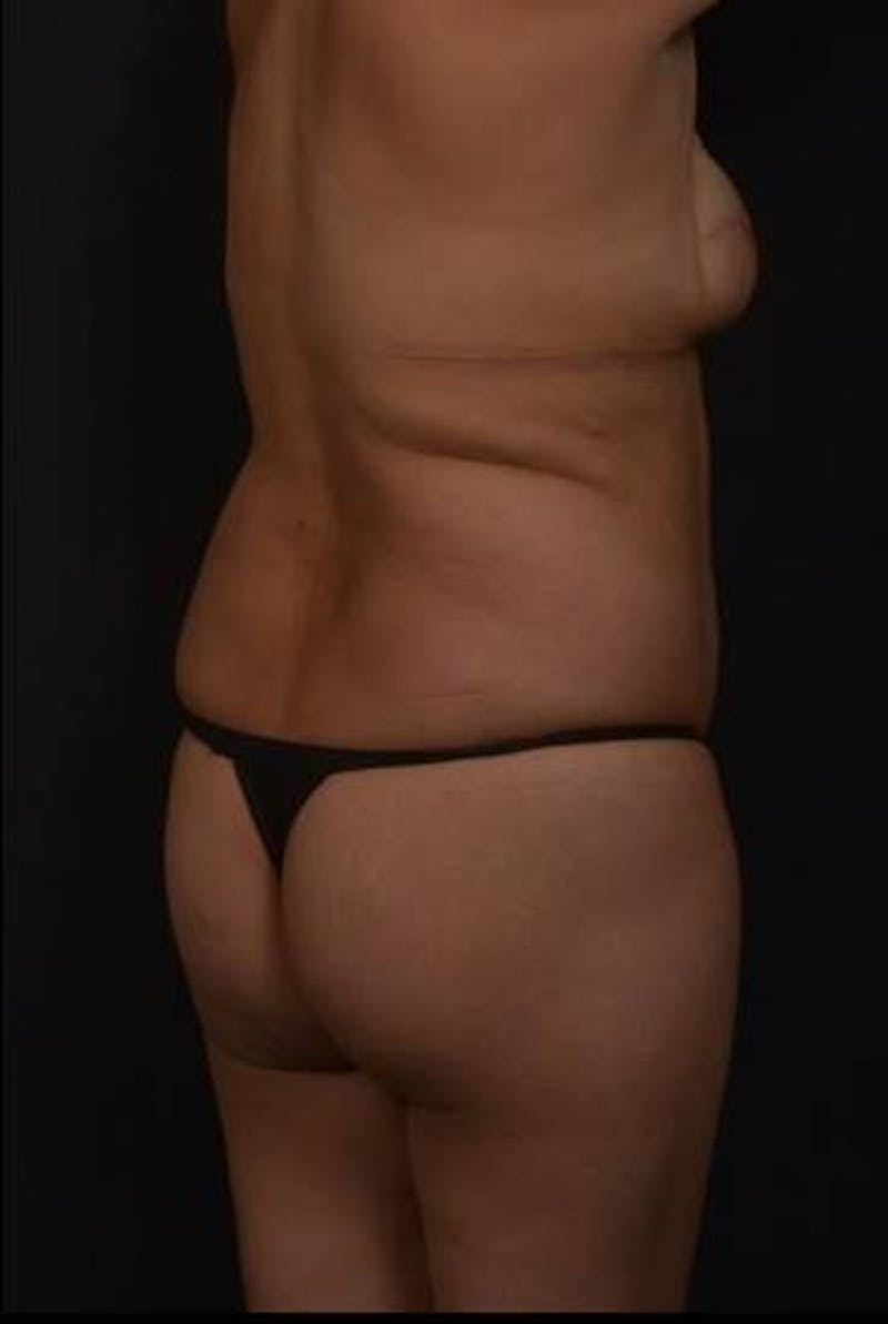 Brazillian Butt Lift Before & After Gallery - Patient 209829 - Image 11