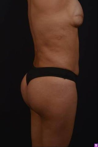 Brazillian Butt Lift Before & After Gallery - Patient 209829 - Image 12