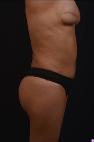 Brazillian Butt Lift Before & After Gallery - Patient 209829 - Image 14