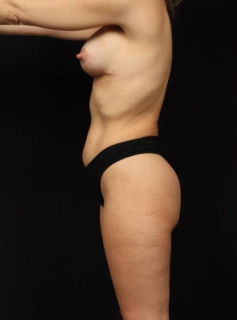 Brazillian Butt Lift Before & After Gallery - Patient 980762 - Image 2