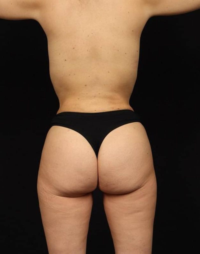 Brazillian Butt Lift Before & After Gallery - Patient 980762 - Image 6