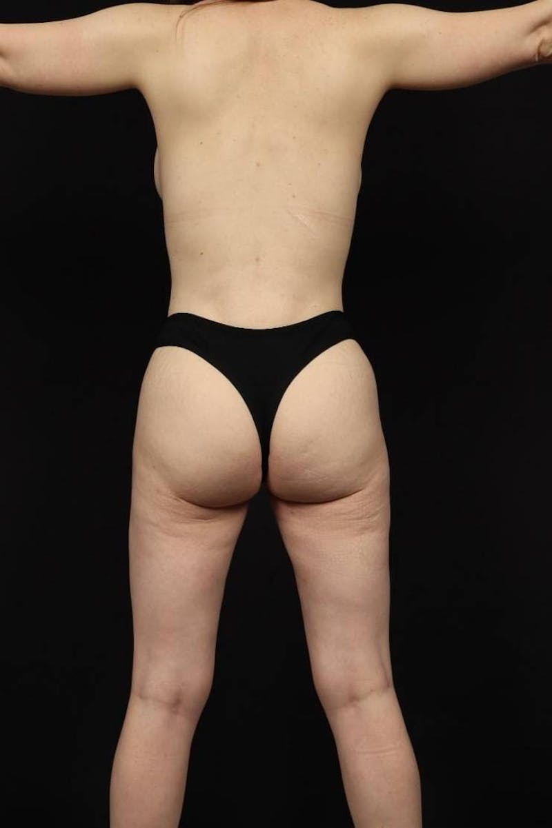 Brazillian Butt Lift Before & After Gallery - Patient 215361 - Image 6