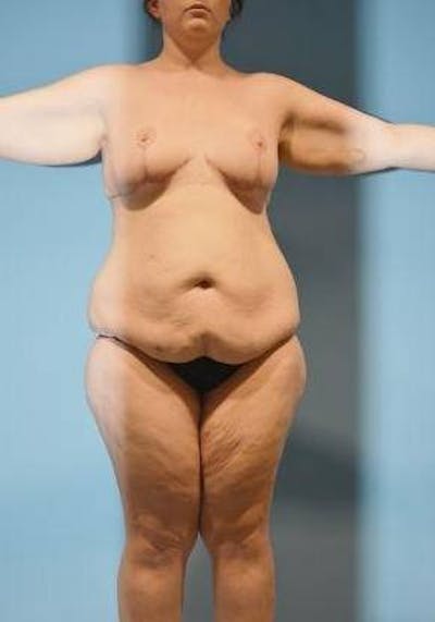 Thigh Lift Before & After Gallery - Patient 281473 - Image 1