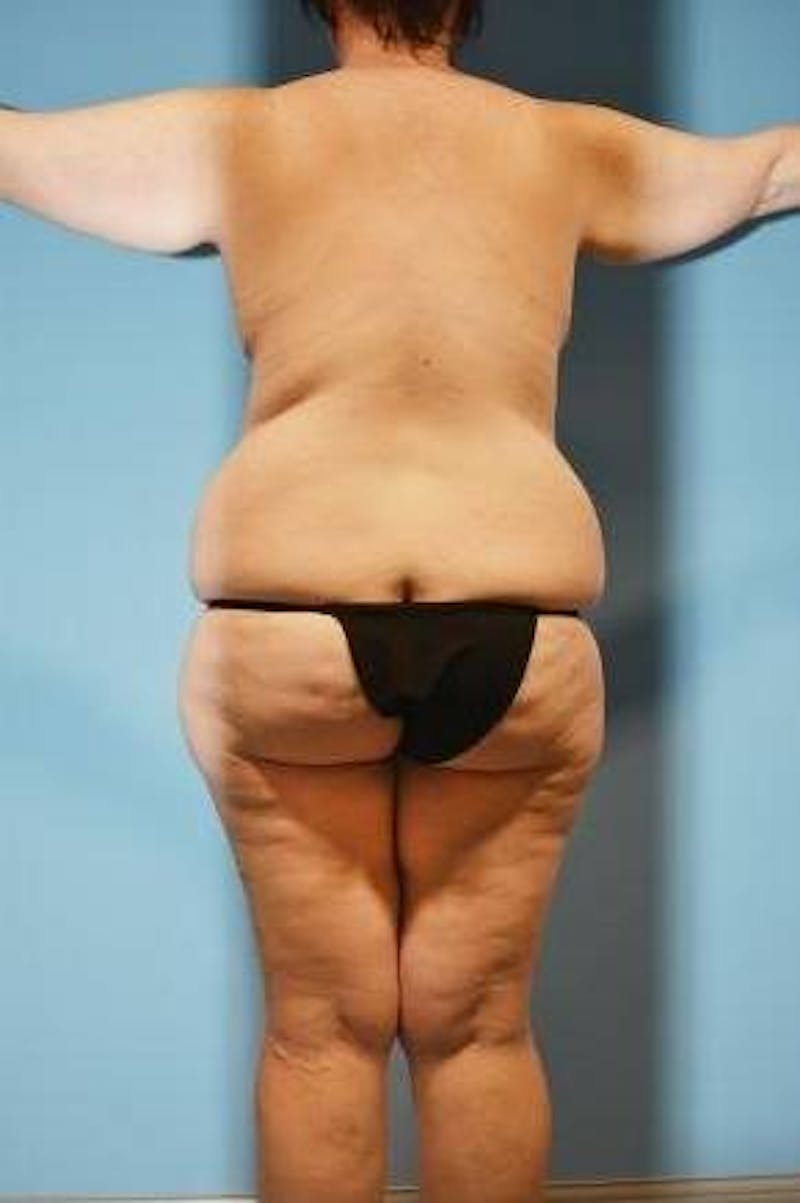 Thigh Lift Before & After Gallery - Patient 281473 - Image 3
