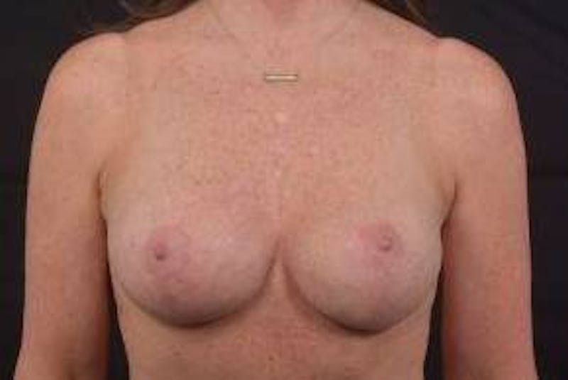 Mommy Makeover Before & After Gallery - Patient 123585 - Image 2