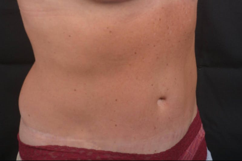 Mommy Makeover Before & After Gallery - Patient 123585 - Image 8