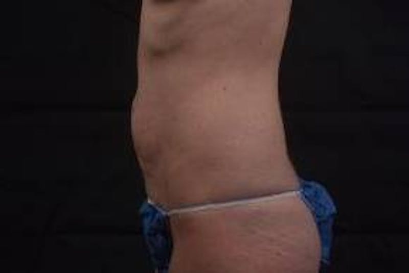 Mommy Makeover Before & After Gallery - Patient 241711 - Image 3