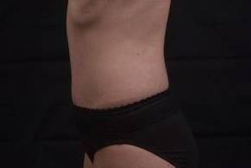 Mommy Makeover Before & After Gallery - Patient 241711 - Image 4