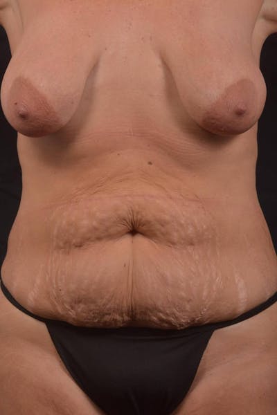 Mommy Makeover Before & After Gallery - Patient 884053 - Image 1