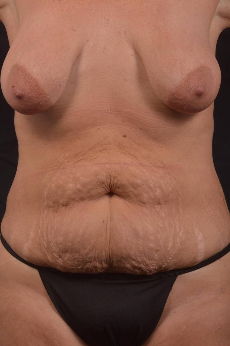 Mommy Makeover Before & After Gallery - Patient 884053 - Image 1