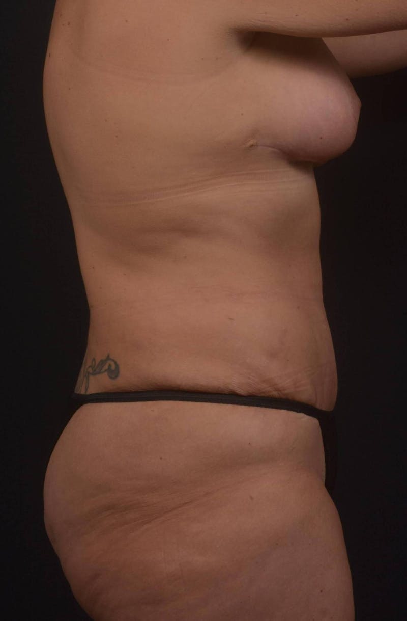 Mommy Makeover Before & After Gallery - Patient 884053 - Image 6