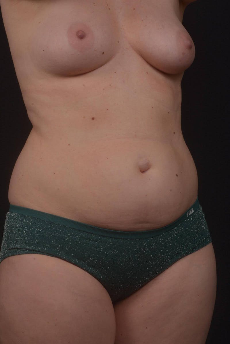 Mommy Makeover Before & After Gallery - Patient 415519 - Image 9
