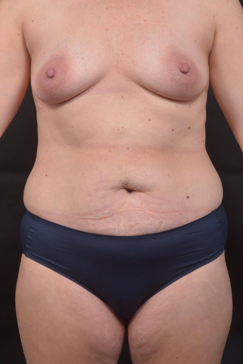 Mommy Makeover Before & After Gallery - Patient 143849 - Image 1
