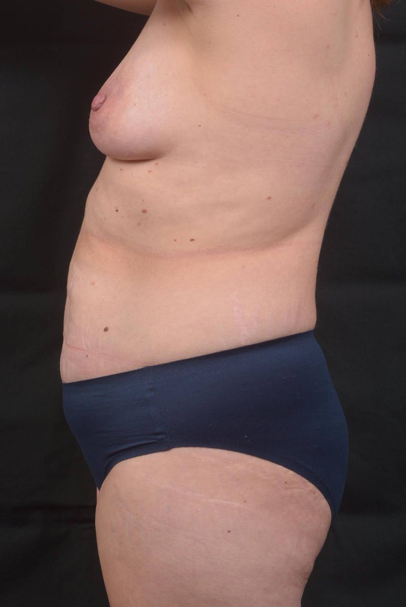 Mommy Makeover Before & After Gallery - Patient 143849 - Image 3