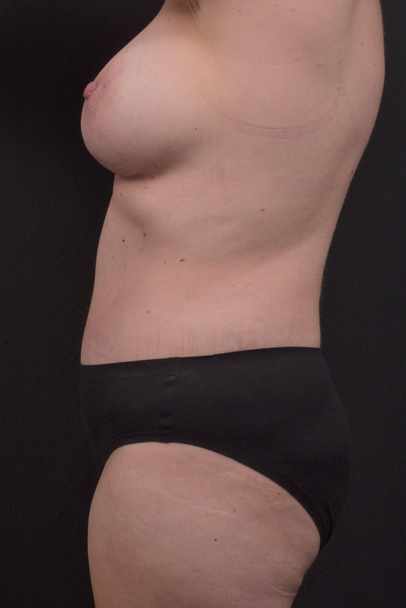 Mommy Makeover Before & After Gallery - Patient 143849 - Image 4