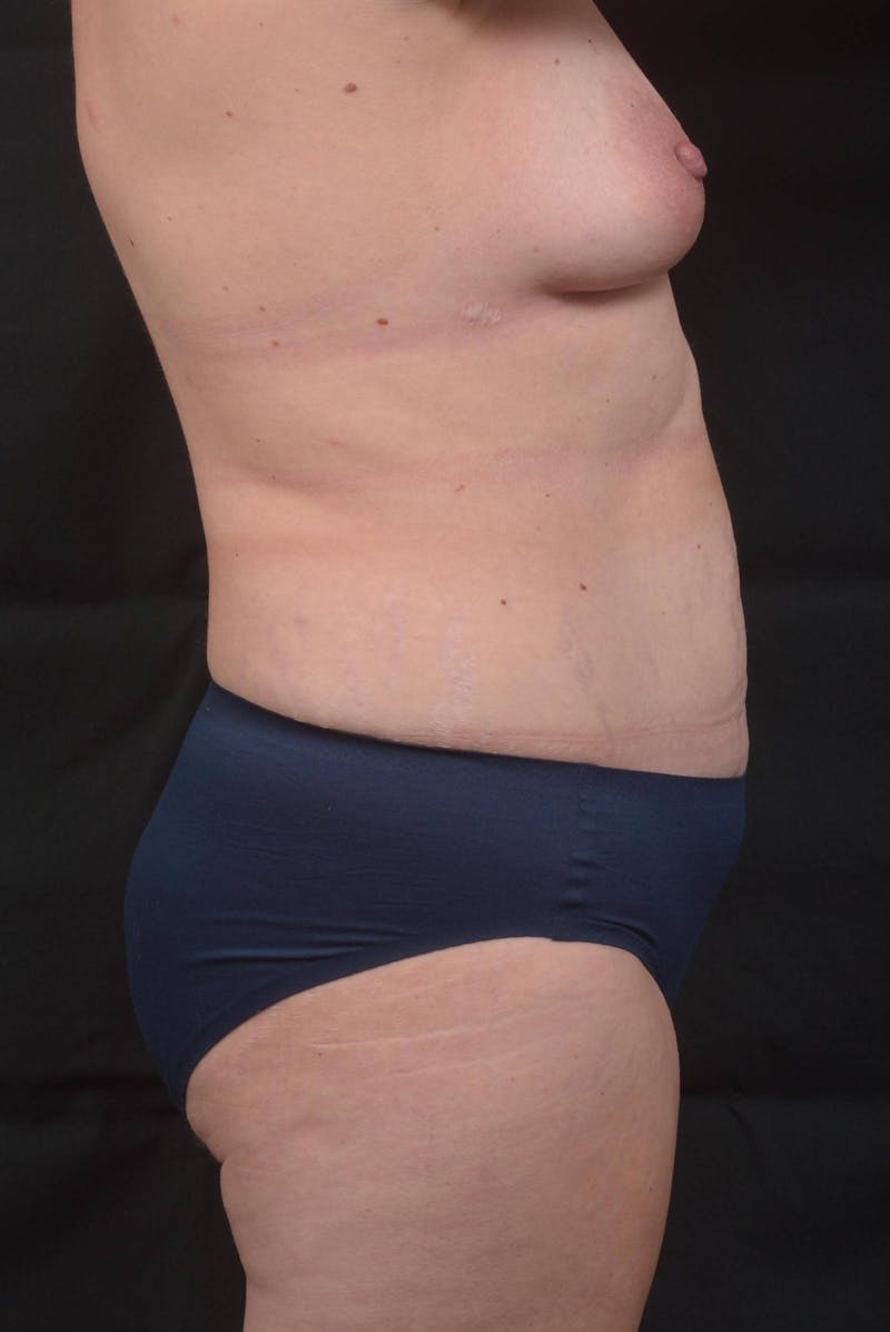 Mommy Makeover Before & After Gallery - Patient 143849 - Image 5