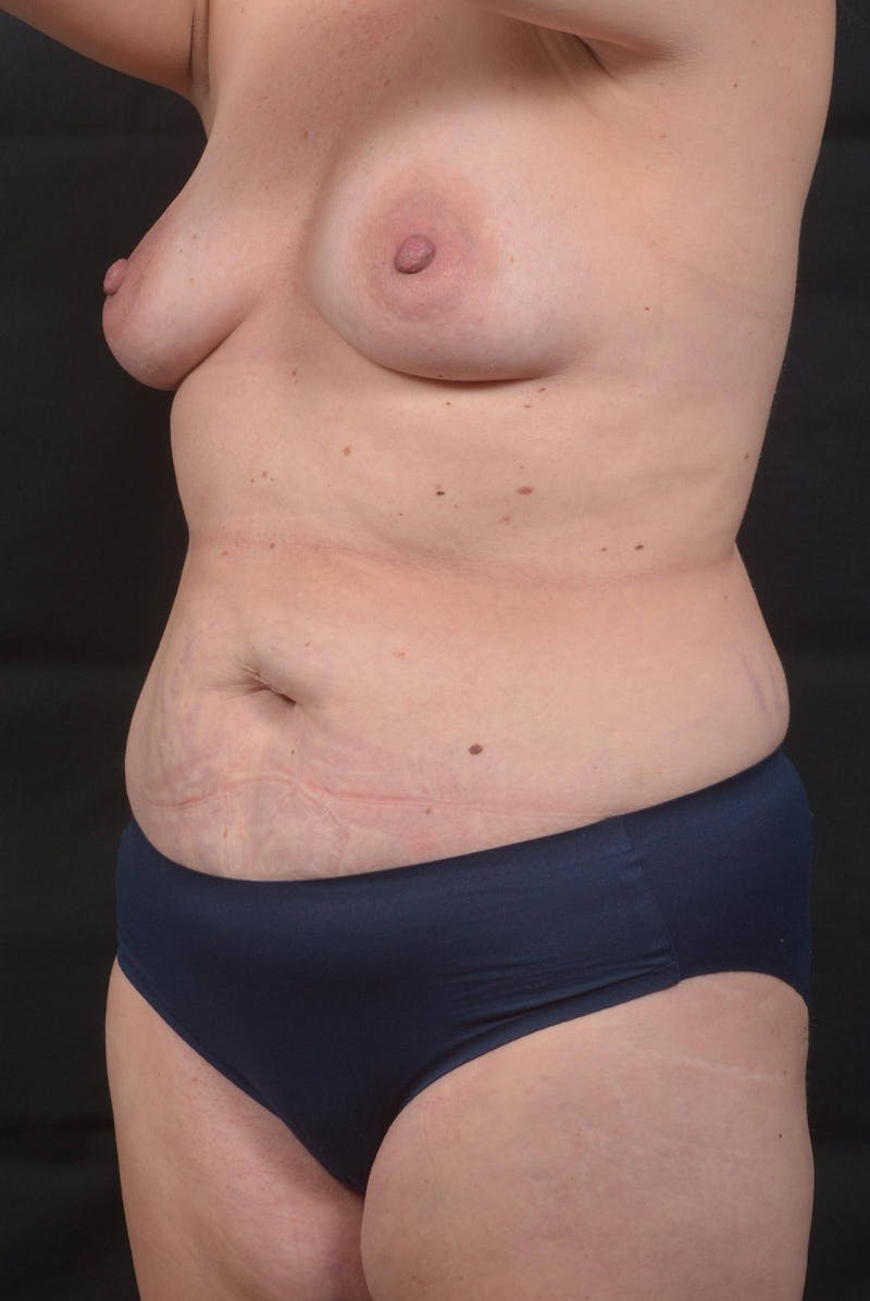 Mommy Makeover Before & After Gallery - Patient 143849 - Image 7