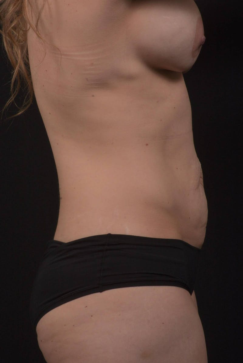 Mommy Makeover Before & After Gallery - Patient 314130 - Image 9