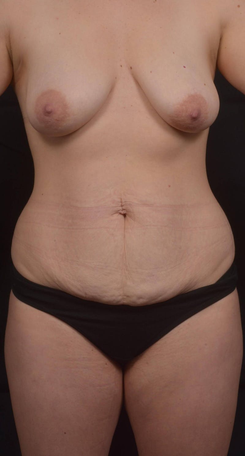 Mommy Makeover Before & After Gallery - Patient 272889 - Image 1