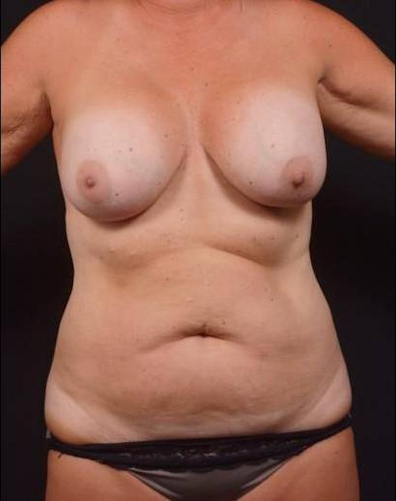 Mommy Makeover Before & After Gallery - Patient 783050 - Image 1