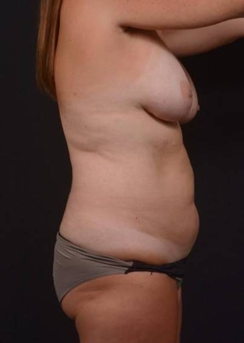 Mommy Makeover Before & After Gallery - Patient 783050 - Image 7