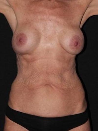 Mommy Makeover Before & After Gallery - Patient 309496 - Image 1