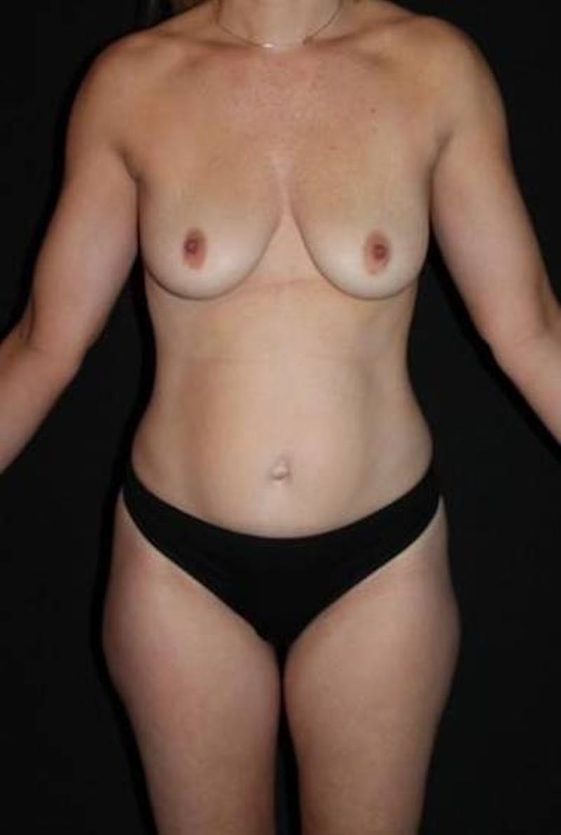 Mommy Makeover Before & After Gallery - Patient 371398 - Image 1