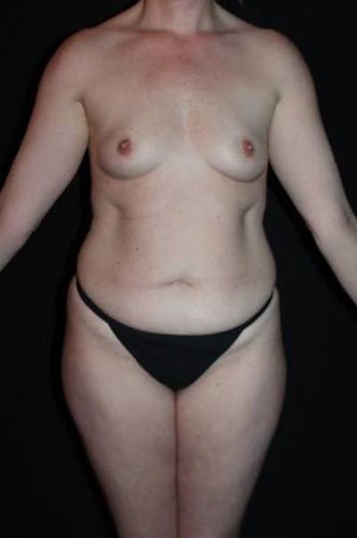 360 Liposuction Before & After Gallery - Patient 153794 - Image 1