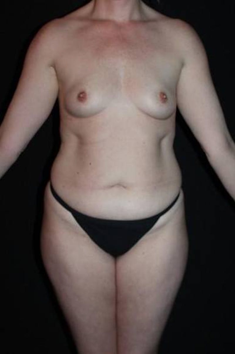 Mommy Makeover Before & After Gallery - Patient 118468 - Image 1