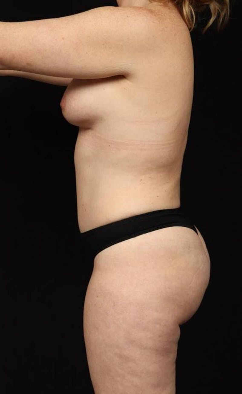 Mommy Makeover Before & After Gallery - Patient 118468 - Image 6