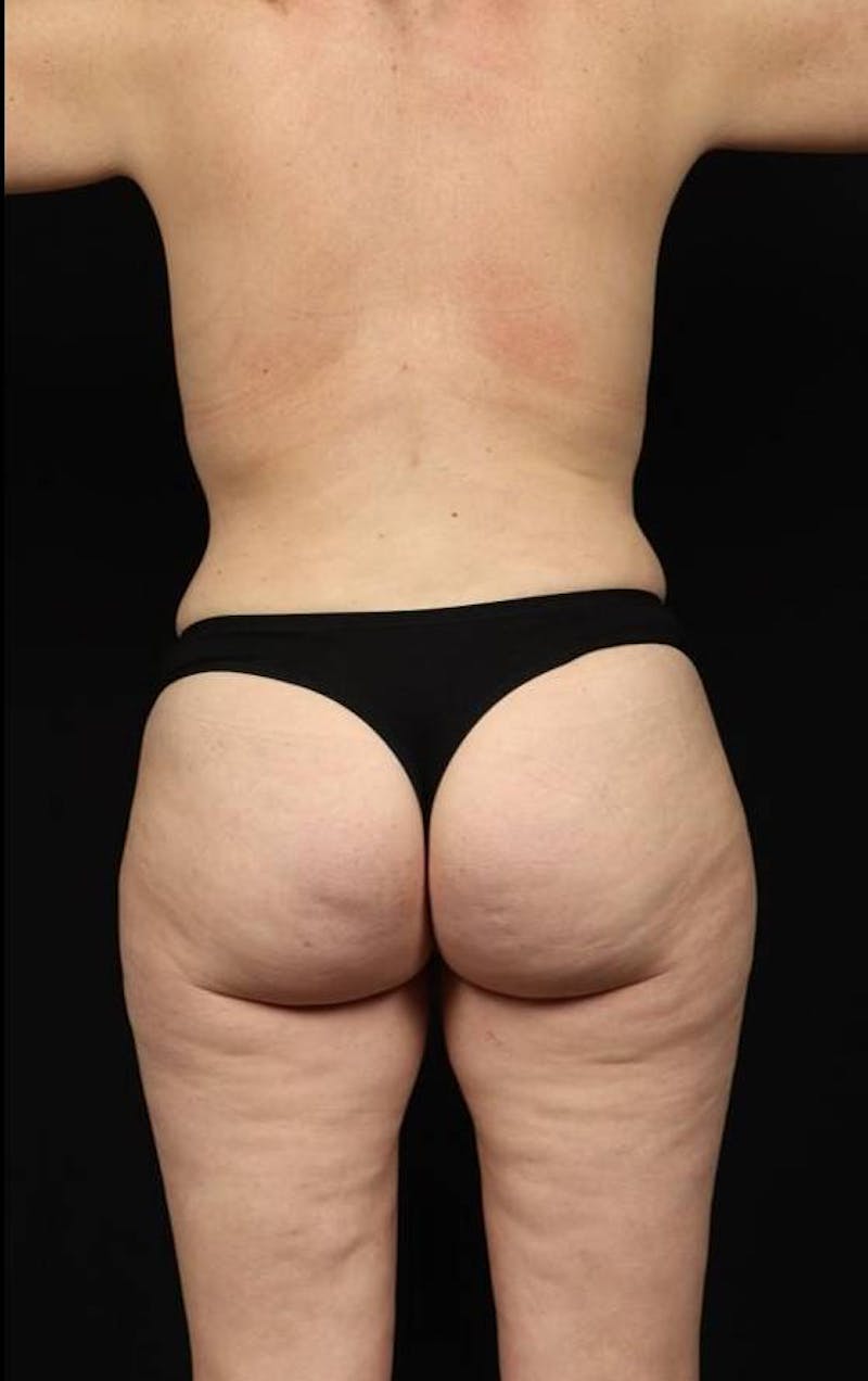 Mommy Makeover Before & After Gallery - Patient 118468 - Image 8