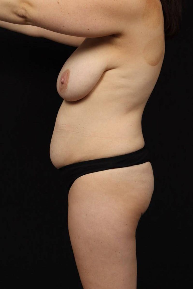 Mommy Makeover Before & After Gallery - Patient 650796 - Image 5