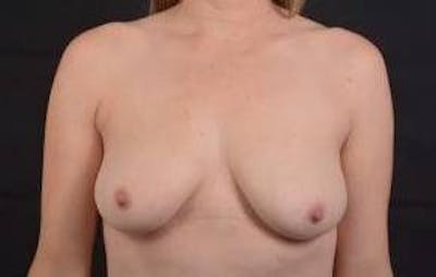 Mommy Makeover Before & After Gallery - Patient 362996 - Image 1