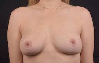 Mommy Makeover Before & After Gallery - Patient 362996 - Image 2
