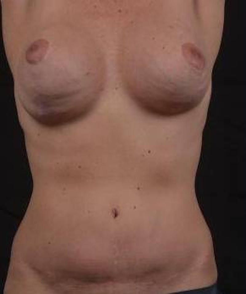 Mommy Makeover Before & After Gallery - Patient 164007 - Image 1