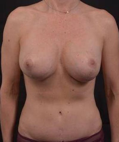 Mommy Makeover Before & After Gallery - Patient 164007 - Image 2