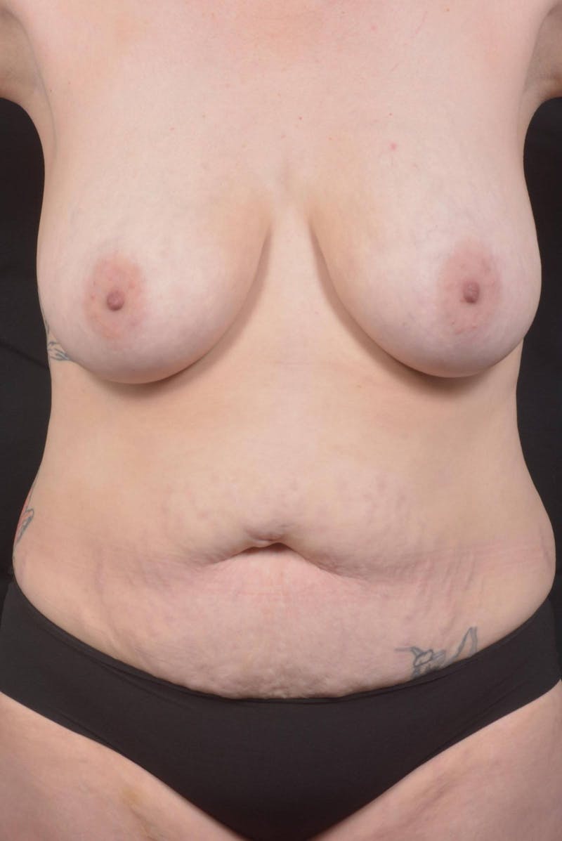 Mommy Makeover Before & After Gallery - Patient 180044 - Image 1
