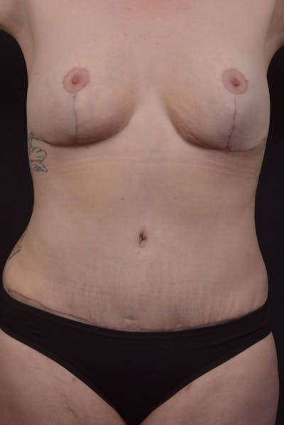 Mommy Makeover Before & After Gallery - Patient 180044 - Image 2