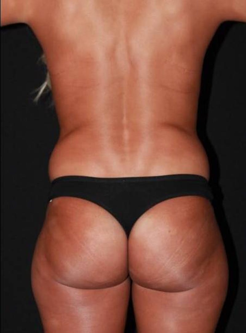 Mommy Makeover Before & After Gallery - Patient 881252 - Image 11