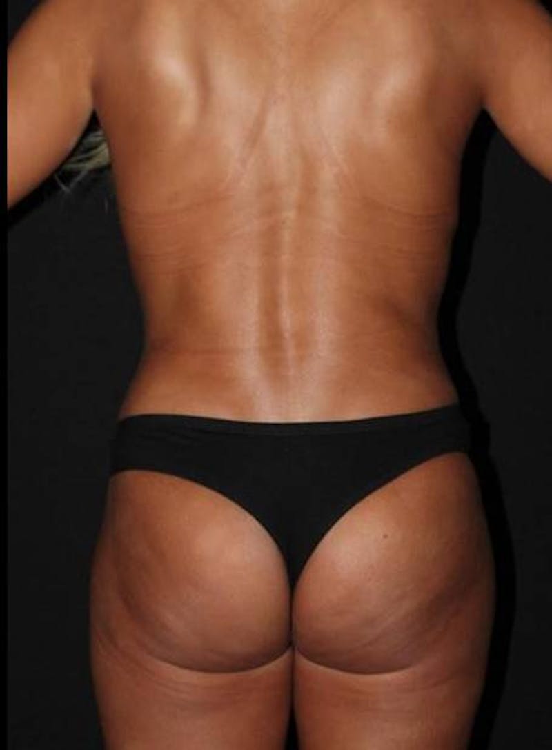 Mommy Makeover Before & After Gallery - Patient 881252 - Image 12