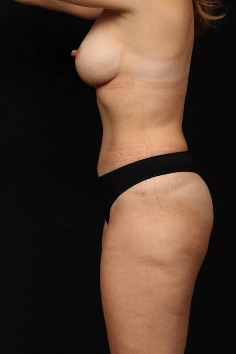 Mommy Makeover Before & After Gallery - Patient 259374 - Image 6